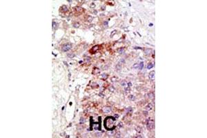Formalin-fixed and paraffin-embedded human hepatocellular carcinoma tissue reacted with PIAS1 polyclonal antibody , which was peroxidase-conjugated to the secondary antibody, followed by DAB staining. (PIAS1 Antikörper  (AA 607-637))