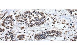 Immunohistochemistry of paraffin-embedded Human esophagus cancer tissue using HNRNPH2 Polyclonal Antibody at dilution of 1:40(x200)