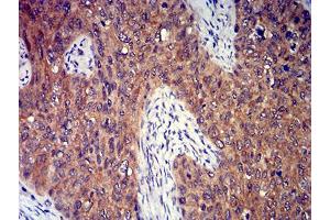 Immunohistochemical analysis of paraffin-embedded cervical cancer tissues using P2RY8 mouse mAb with DAB staining. (P2RY8 Antikörper)