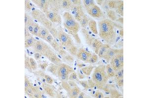 Immunohistochemistry of paraffin-embedded human liver cancer using BLVRB antibody at dilution of 1:100 (40x lens).