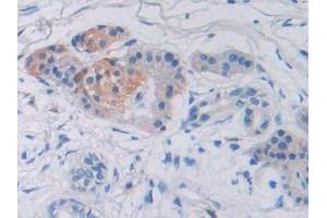 Detection of SUMF1 in Human Prostate cancer Tissue using Polyclonal Antibody to Sulfatase Modifying Factor 1 (SUMF1) (SUMF1 Antikörper  (AA 113-356))