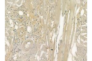 ABIN6262009 and ABIN6277234 at 1/100 staining human tongue carcinoma by IHC-P.
