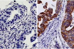 Paraffin embedded human gastric cancer tissue was stained with Mouse IgG2b-HRP isotype control followed by DAB and hematoxylin.