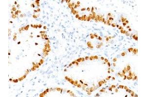 Formalin-fixed, paraffin-embedded human lung Adenocarcinoma stained with TTF1 antibody (NX2. (TTF1 Antikörper)