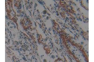 DAB staining on IHC-P; Samples: Human Lung cancer Tissue (Nischarin Antikörper  (AA 1246-1346))