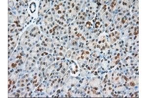 Immunohistochemical staining of paraffin-embedded Adenocarcinoma of Human colon tissue using anti-USP5 mouse monoclonal antibody. (USP5 Antikörper)