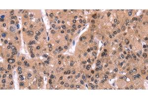 Immunohistochemistry of paraffin-embedded Human liver cancer using ARC Polyclonal Antibody at dilution of 1:50 (ARC Antikörper)