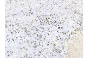 ABIN6256428 and ABIN6267317 at 1/100 staining human gastric carcinoma by IHC-P. (Retinoblastoma Protein (Rb) Antikörper  (pSer807))