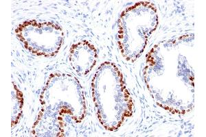 Formalin-fixed, paraffin-embedded human Prostate Cancer stained with p63 Rabbit Monoclonal Antibody (TP63/1423R). (p63 Antikörper)