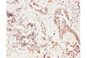 IHC-P: Eotaxin 3 antibody testing of human lung cancer tissue (CCL26 Antikörper  (AA 24-94))