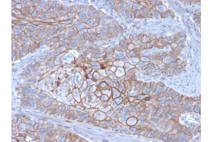 Immunohistochemistry (IHC) image for anti-Cadherin 1, Type 1, E-Cadherin (Epithelial) (CDH1) (AA 567-691) antibody (ABIN6941293)