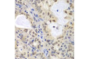 Immunohistochemistry of paraffin-embedded human oophoroma using MCM3 antibody (ABIN5970419) at dilution of 1/100 (40x lens). (MCM3 Antikörper)