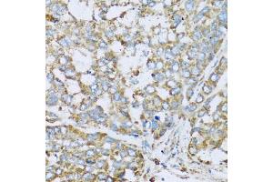 Immunohistochemistry of paraffin-embedded human liver cancer using COX6A1 antibody. (COX6A1 Antikörper)