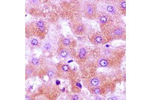 Immunohistochemical analysis of CBLB staining in human liver cancer formalin fixed paraffin embedded tissue section.