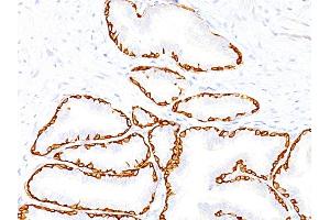 Formalin-fixed, paraffin-embedded human Prostate Carcinoma stained with Cytokeratin 14 Monoclonal Antibody (SPM263). (KRT14 Antikörper  (C-Term))