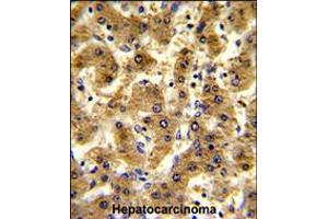 Formalin-fixed and paraffin-embedded human hepatocarcinoma reacted with ADH1B Antibody , which was peroxidase-conjugated to the secondary antibody, followed by DAB staining. (ADH1B Antikörper  (AA 209-237))