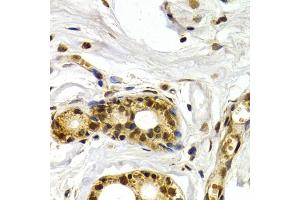 Immunohistochemistry of paraffin-embedded human mammary gland using ATF2 antibody (ABIN5971182) at dilution of 1/200 (40x lens). (ATF2 Antikörper)