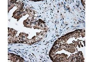 Immunohistochemical staining of paraffin-embedded Carcinoma of liver tissue using anti-PSMC3 mouse monoclonal antibody. (PSMC3 Antikörper)