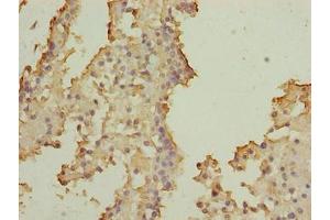 Immunohistochemistry of paraffin-embedded human breast cancer using ABIN7170508 at dilution of 1:100 (SOHLH2 Antikörper  (AA 1-225))