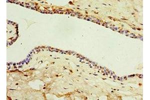 Immunohistochemistry of paraffin-embedded human breast cancer using ABIN7156854 at dilution of 1:100 (IL22 Receptor alpha 1 Antikörper  (AA 16-230))