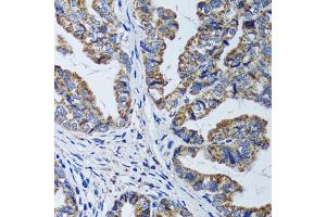 Immunohistochemistry of paraffin-embedded human gastric cancer using ATP5B antibody (ABIN5973391) at dilution of 1/100 (40x lens).