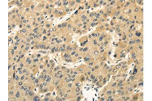 The image on the left is immunohistochemistry of paraffin-embedded Human liver cancer tissue using ABIN7130214(MED16 Antibody) at dilution 1/30, on the right is treated with fusion protein. (MED16 Antikörper)
