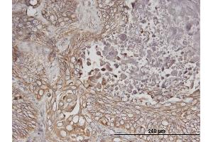 Immunoperoxidase of monoclonal antibody to ERBB3 on formalin-fixed paraffin-embedded human lung cancer. (ERBB3 Antikörper  (AA 1-130))