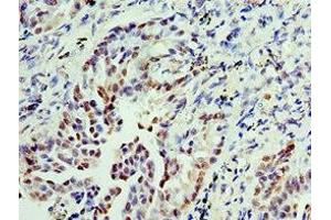 Immunohistochemistry of paraffin-embedded human lung cancer using ABIN7156290 at dilution of 1:100 (IMPDH2 Antikörper  (AA 215-514))