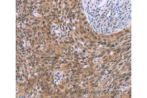 Immunohistochemistry of Human liver cancer using GLYR1 Polyclonal Antibody at dilution of 1:30 (GLYR1 Antikörper)