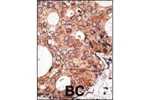 Formalin-fixed and paraffin-embedded human cancer tissue reacted with the primary antibody, which was peroxidase-conjugated to the secondary antibody, followed by AEC staining. (MAGEA10 Antikörper  (C-Term))