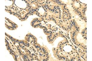 The image on the left is immunohistochemistry of paraffin-embedded Human thyroid cancer tissue using ABIN7130214(MED16 Antibody) at dilution 1/30, on the right is treated with fusion protein. (MED16 Antikörper)