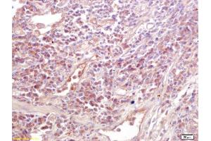 Formalin-fixed and paraffin embedded human lung carcinoma labeled with Anti-MICA/MHC I a Polyclonal Antibody, Unconjugated (ABIN728788) at 1:200 followed by conjugation to the secondary antibody and DAB staining. (MICA Antikörper  (AA 120-170))