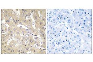 Immunohistochemistry analysis of paraffin-embedded human liver carcinoma tissue, using TNAP2 antibody.
