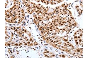 The image on the left is immunohistochemistry of paraffin-embedded Human lung cancer tissue using ABIN7193127(Map2 Antibody) at dilution 1/40, on the right is treated with synthetic peptide. (MAP2 Antikörper)