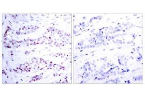 Immunohistochemical analysis of paraffin-embedded human breast carcinoma tissue using STAT6 (Ab-641) antibody (E021050). (STAT6 Antikörper)