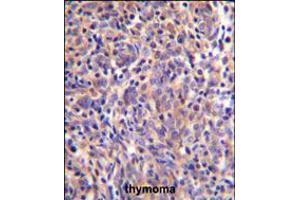 THEMIS Antibody immunohistochemistry analysis in formalin fixed and paraffin embedded human thymoma followed by peroxidase conjugation of the secondary antibody and DAB staining. (THEMIS Antikörper  (C-Term))