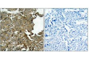 Immunohistochemical analysis of paraffin-embedded human breast carcinoma tissue using cofilin(Ab-3) Antibody(left) or the same antibody preincubated with blocking peptide(right). (Cofilin Antikörper  (AA 1-5))