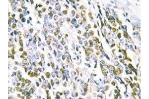 Immunohistochemistry analyzes of MRE11 antibody in paraffin-embedded human lung carcinoma tissue. (Mre11 Antikörper)