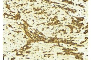 ABIN6269248 at 1/100 staining Human breast cancer tissue by IHC-P. (STAT5A Antikörper  (C-Term))