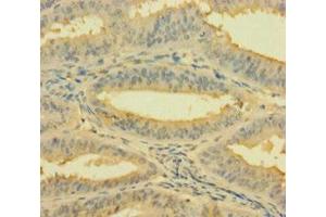 Immunohistochemistry of paraffin-embedded human endometrial cancer using ABIN7142784 at dilution of 1:100 (RPL26L1 Antikörper  (AA 1-145))