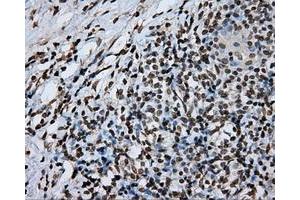 Immunohistochemical staining of paraffin-embedded Adenocarcinoma of ovary tissue using anti-DAPK2 mouse monoclonal antibody. (DAPK2 Antikörper)