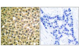 Immunohistochemical analysis of paraffin-embedded human breast carcinoma tissue using Retinoic Acid Receptor beta antibody (ABIN5976499). (Retinoic Acid Receptor beta Antikörper  (C-Term))