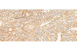 Immunohistochemistry of paraffin-embedded Human gastric cancer tissue using KRT9 Polyclonal Antibody at dilution of 1:30(x200) (KRT9 Antikörper)