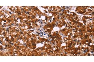 Immunohistochemistry of paraffin-embedded Human thyroid cancer tissue using ART5 Polyclonal Antibody at dilution 1:50