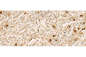 Immunohistochemistry of paraffin-embedded Human gastric cancer tissue using TBCK Polyclonal Antibody at dilution of 1:25(x200) (TBCK Antikörper)
