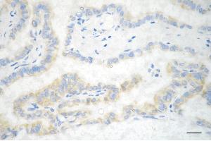 Immunohistochemistry was performed on paraffin-embedded human papillary thyroid carcinoma using CLPTM1 antibody (ABIN7798098), 1:200).