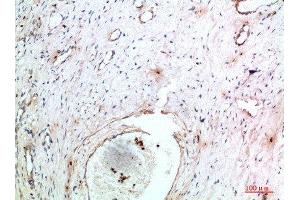 Immunohistochemical analysis of paraffin-embedded human-cervical-cancer, antibody was diluted at 1:200 (TNIP2 Antikörper  (AA 61-110))