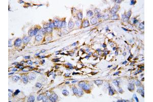 Anti-MIG antibody, IHC(P) IHC(P): Human Lung Cancer Tissue