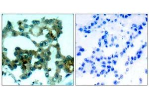 Immunohistochemical analysis of paraffin-embedded human lung carcinoma tissue, using PKCβ (Ab-641) antibody (E021184). (PKC beta Antikörper)