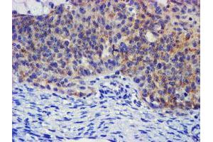 Immunohistochemical staining of paraffin-embedded Adenocarcinoma of Human ovary tissue using anti-PLDN mouse monoclonal antibody. (Pallidin Antikörper)